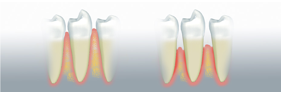 schwarzwaldzahn-leistung-parodontologie-initialtherapie